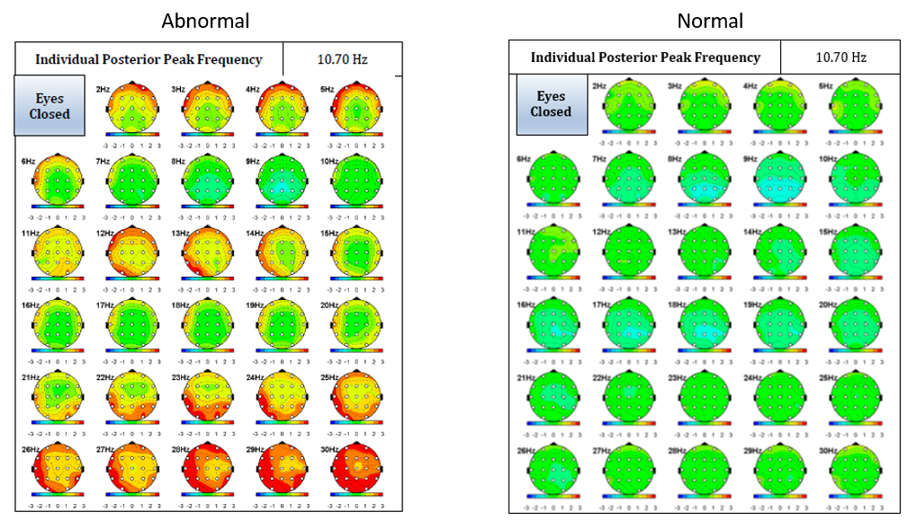 Neurofeedback Results