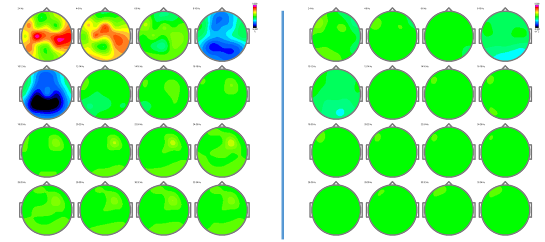 30 Neurofeedback Sessions Results