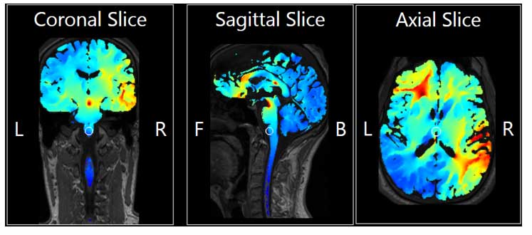 Neurofeedback Therapy Results