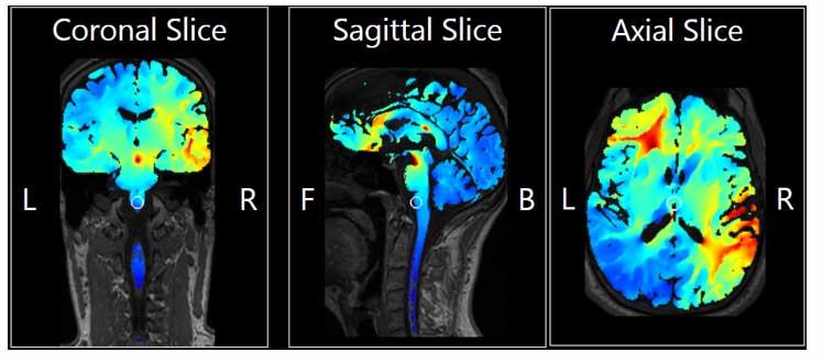 Neurofeedback Therapy Results